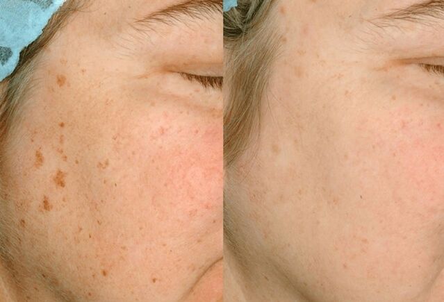 Retirer la pigmentation de la peau