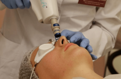 Rajeunissement laser notable