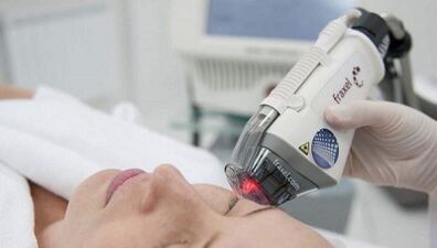 Comment se déroule le resurfaçage fractionné de la peau 